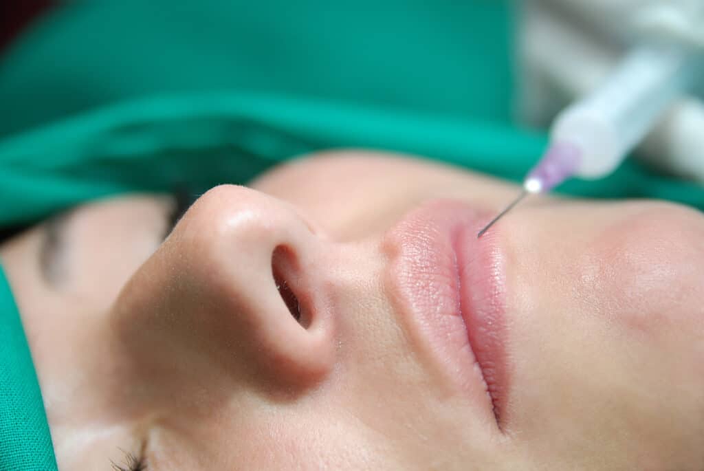 Lip Filler Augmentation | Prick'd Medspa in St. Louis, MO
