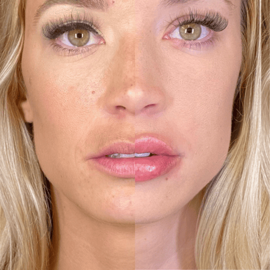 Lip Filler Before and After Photos | Prick'd Medspa in St. Louis, MO