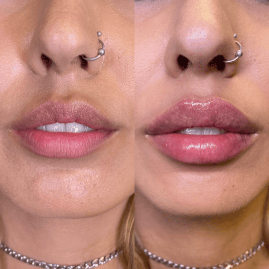 Lip Filler Before and After Photos | Prick'd Medspa in St. Louis, MO