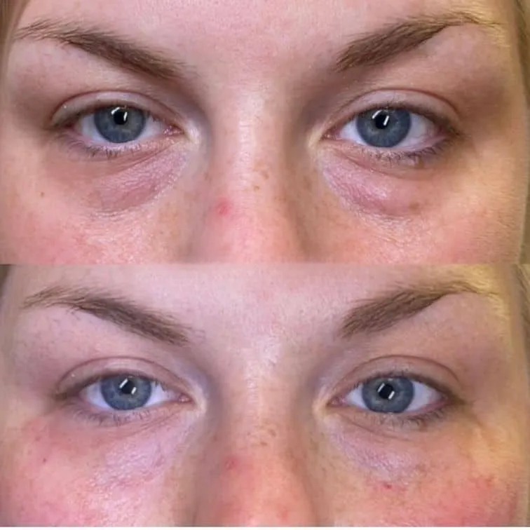 Tear Through Rejuvenation Before and After Photos | Prick'd Medspa in St. Louis, MO