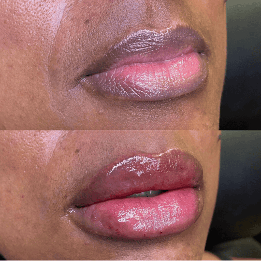 Lip Filler Before and After Photos | Prick'd Medspa in St. Louis, MO