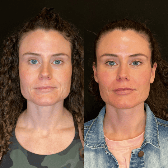 Masseter Tox Before and After Photos | Prick'd Medspa in St. Louis, MO