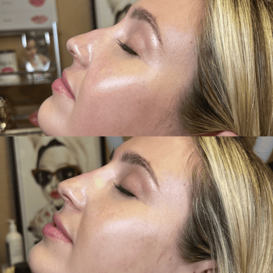 Liquid Rhinoplasty Before and After Photos | Prick'd Medspa in St. Louis, MO