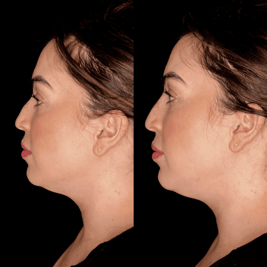 Liquid Rhinoplasty Before and After Photos | Prick'd Medspa in St. Louis, MO