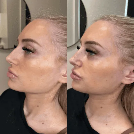 Liquid Rhinoplasty Before and After Photos | Prick'd Medspa in St. Louis, MO