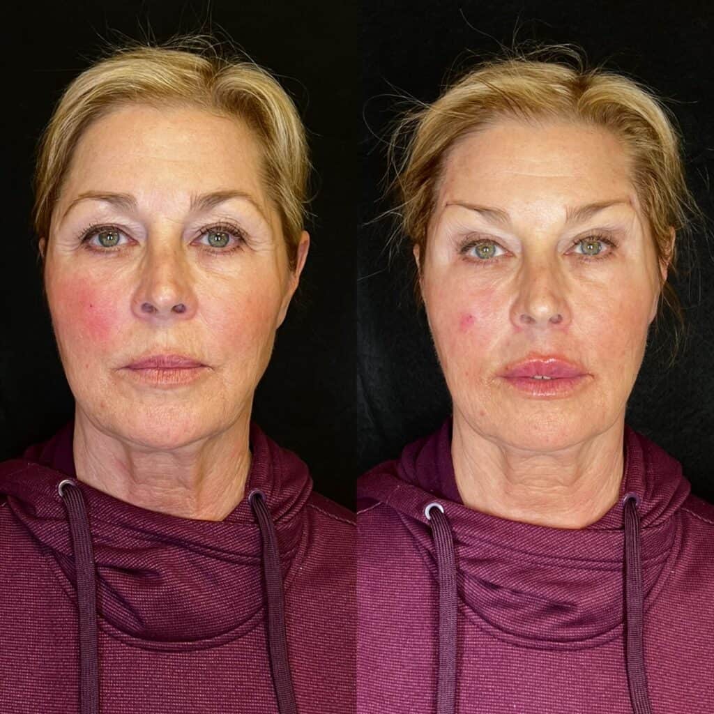 Brow PDO Thread Lift and Lip Filler Before and After Photos | Prick'd Medspa in St. Louis, MO