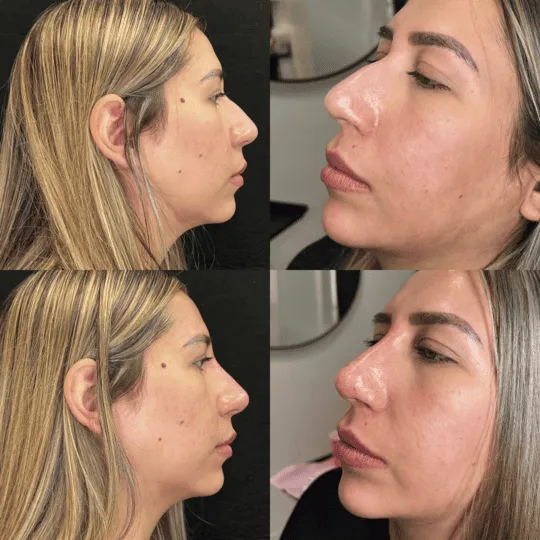 Liquid Rhinoplasty Before and After Photos | Prick'd Medspa in St. Louis, MO