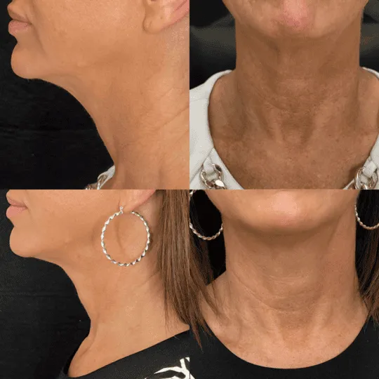 Neck Rejuvenation Before and After Photos | Prick'd Medspa in St. Louis, MO