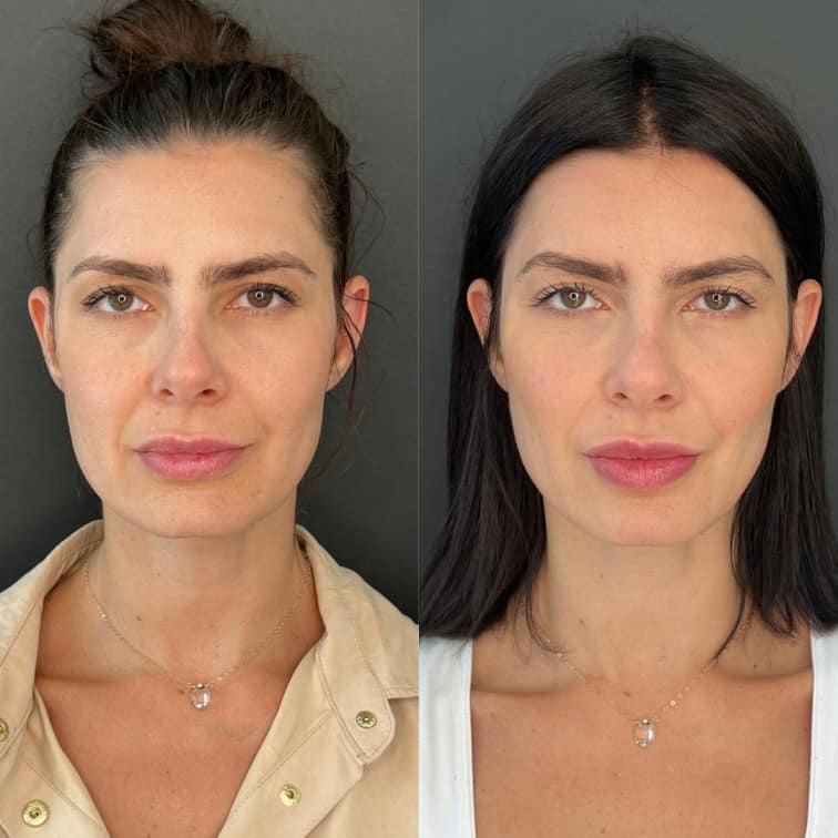 Full Face Rejuvenation Before and After Photos | Prick'd Medspa in St. Louis, MO