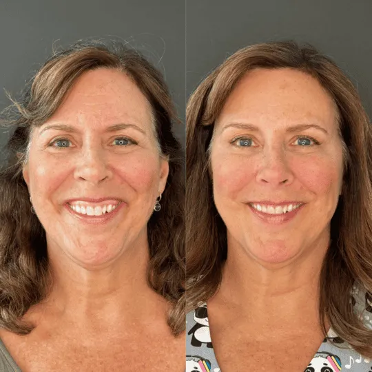 Gummy Smile Tox Before and After Photos | Prick'd Medspa in St. Louis, MO