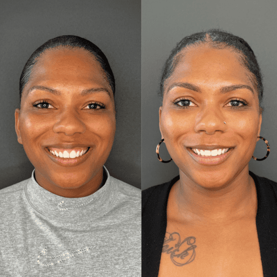 Gummy Smile Tox Before and After Photos | Prick'd Medspa in St. Louis, MO
