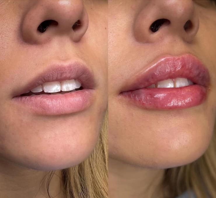 Lip Filler Before and After Photos | Prick'd Medspa in St. Louis, MO