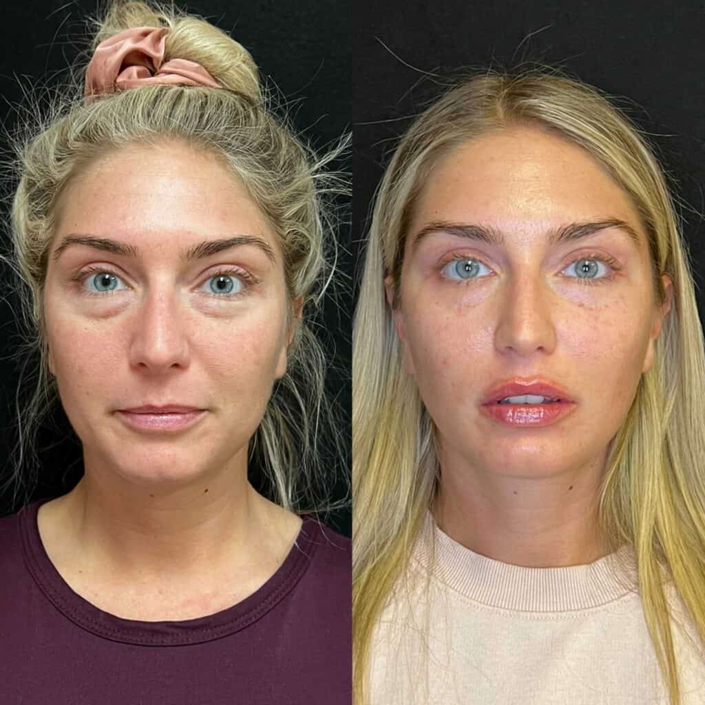 Midface, Eye and Lip Rejuvenation Before and After Photos | Prick'd Medspa in St. Louis, MO