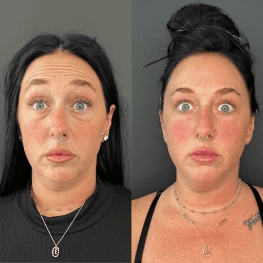 Crows Feet Botox Before and After Photos | Prick'd Medspa in St. Louis, MO