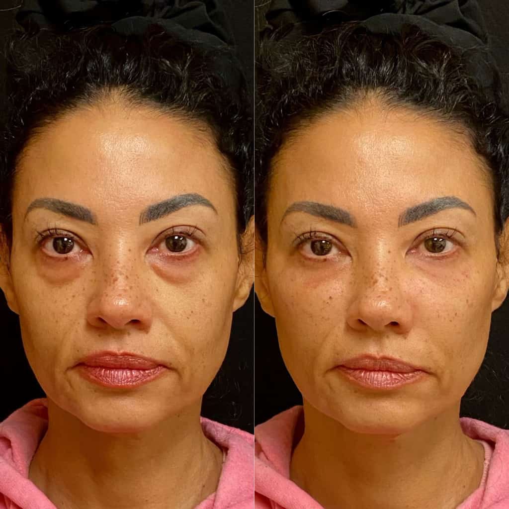 Tear Through Rejuvenation Before and After Photos | Prick'd Medspa in St. Louis, MO