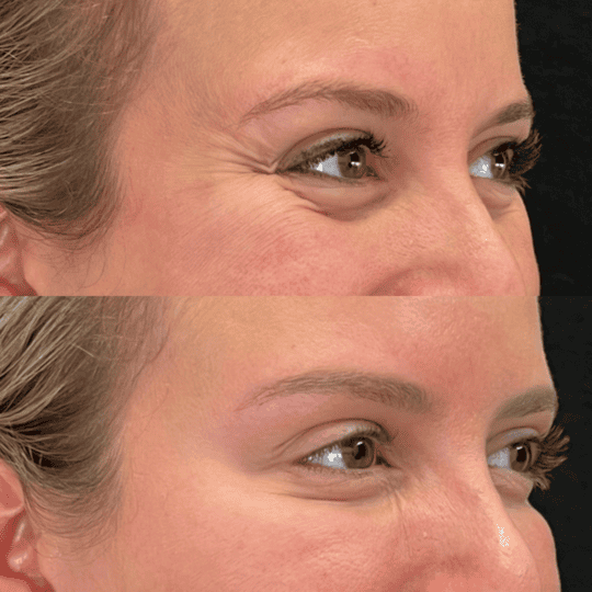 Crows Feet Botox Before and After Photos | Prick'd Medspa in St. Louis, MO
