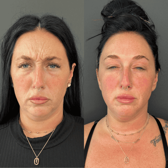 Crows Feet Botox Before and After Photos | Prick'd Medspa in St. Louis, MO