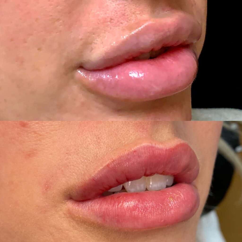 Lip Filler Dissolving Before and After Photos | Prick'd Medspa in St. Louis, MO