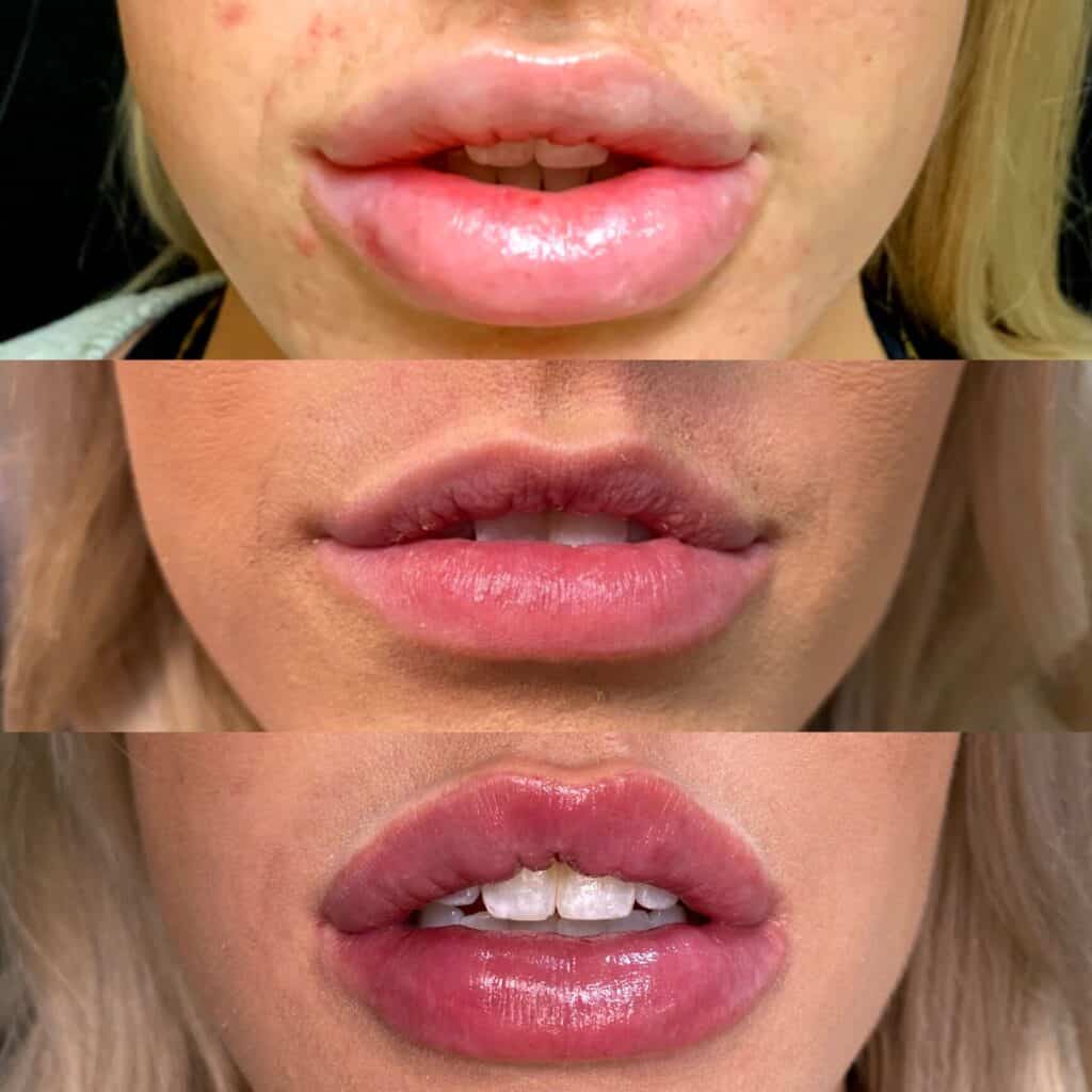 Lip Filler Dissolving Before and After Photos | Prick'd Medspa in St. Louis, MO
